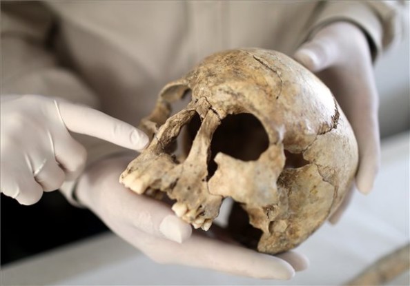 A lepra legkorábbi nyomai egy koponyán (MTI Fotók: Mohai Balázs)